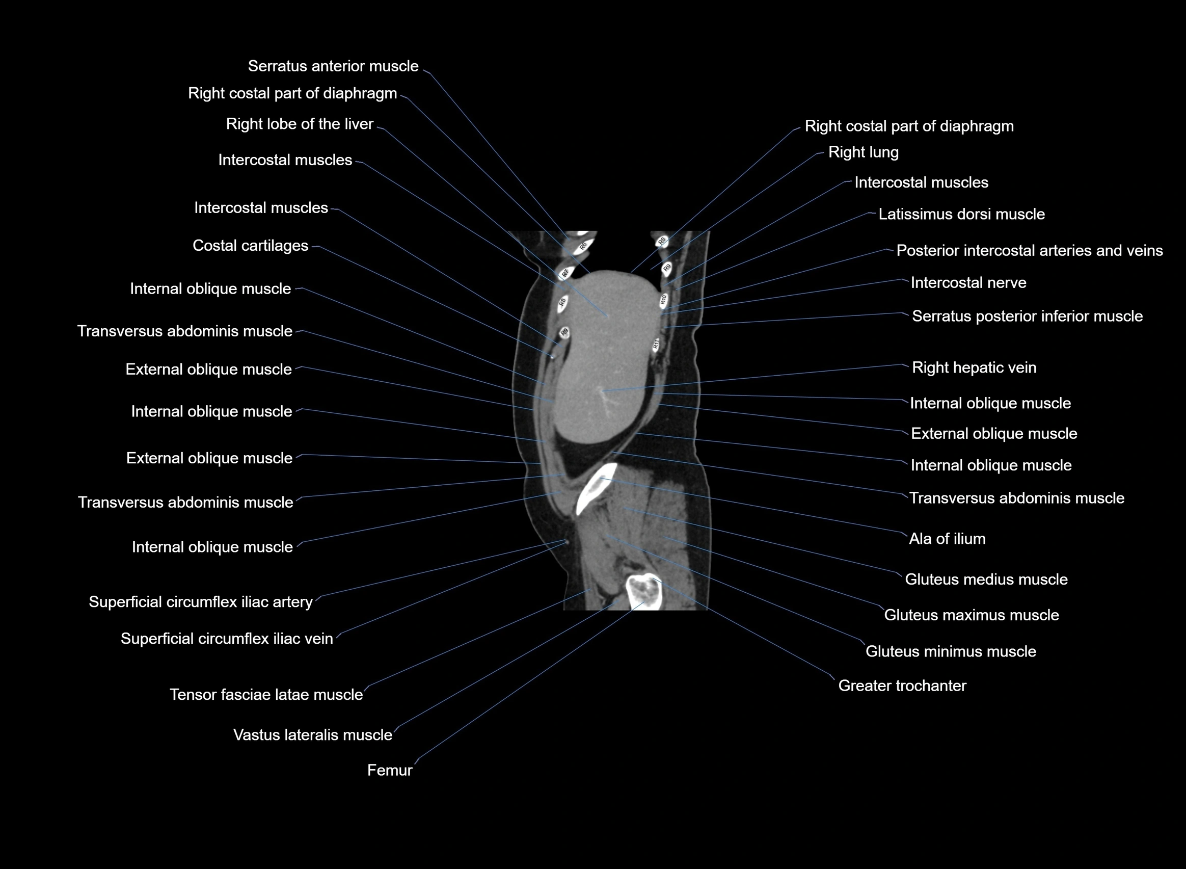 CT Abdomen sagittal cross sectional anatomy labelled radiology image -00098.webp